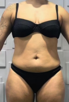 Ana Silva - Antes